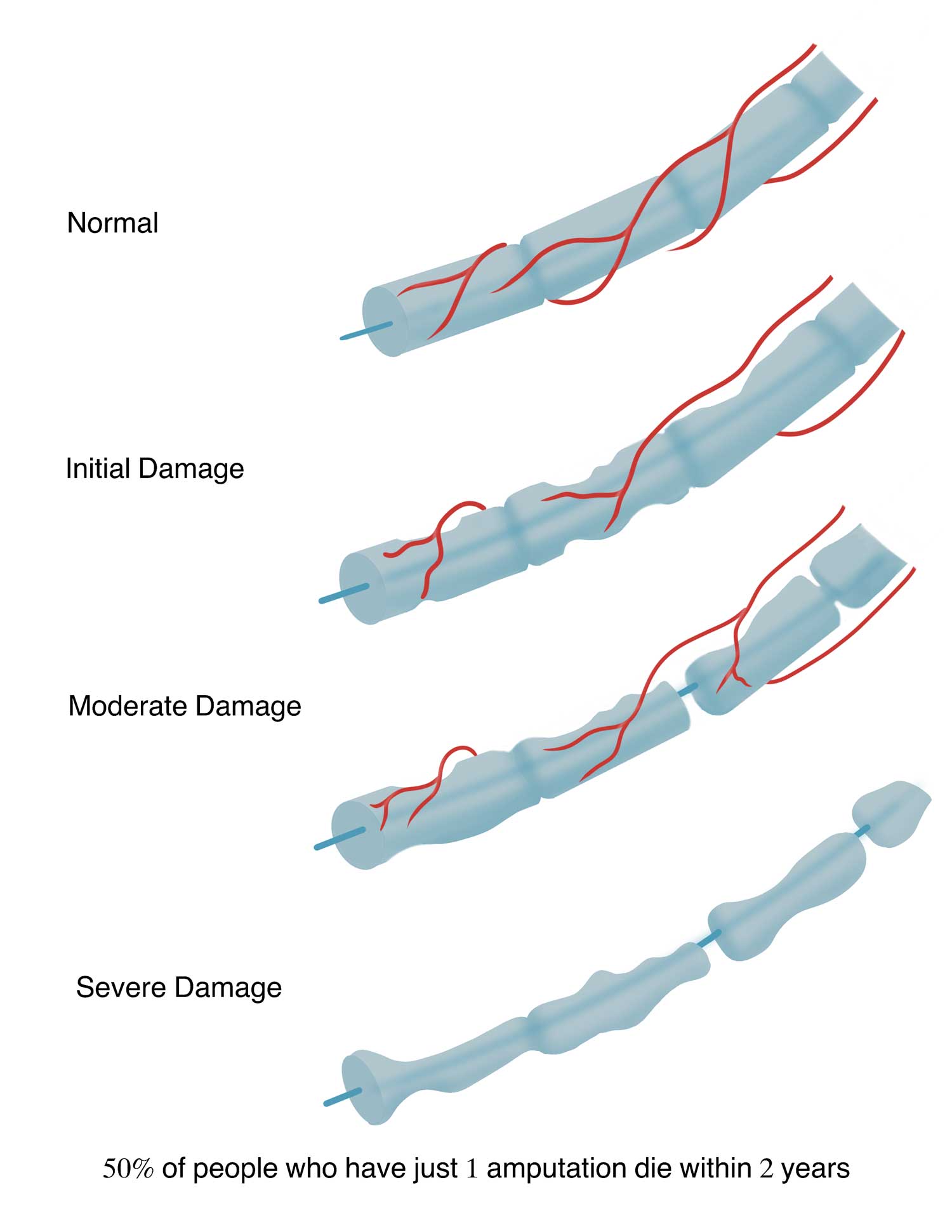 Neuropathy-Progression